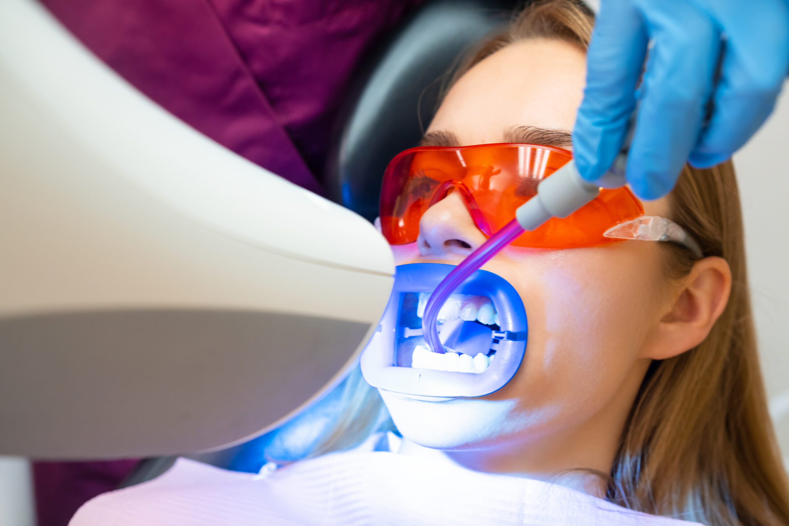 tipos de blanqueamiento dental